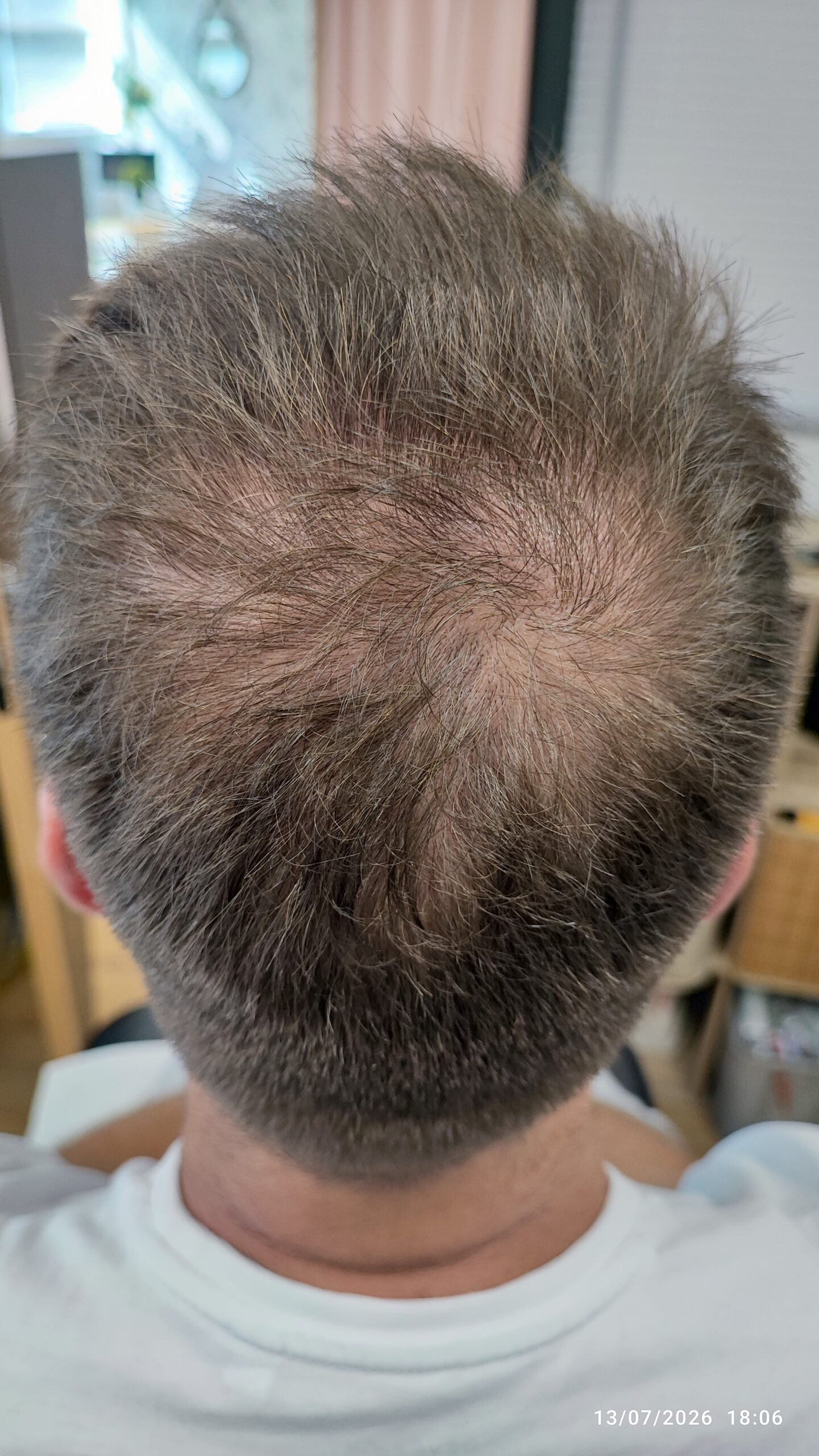 Vertex clairsemé avant la première séance RegenX - Regen'HairSkin
