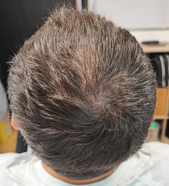 Vertex clairsemé avant la première séance RegenX - Regen'HairSkin