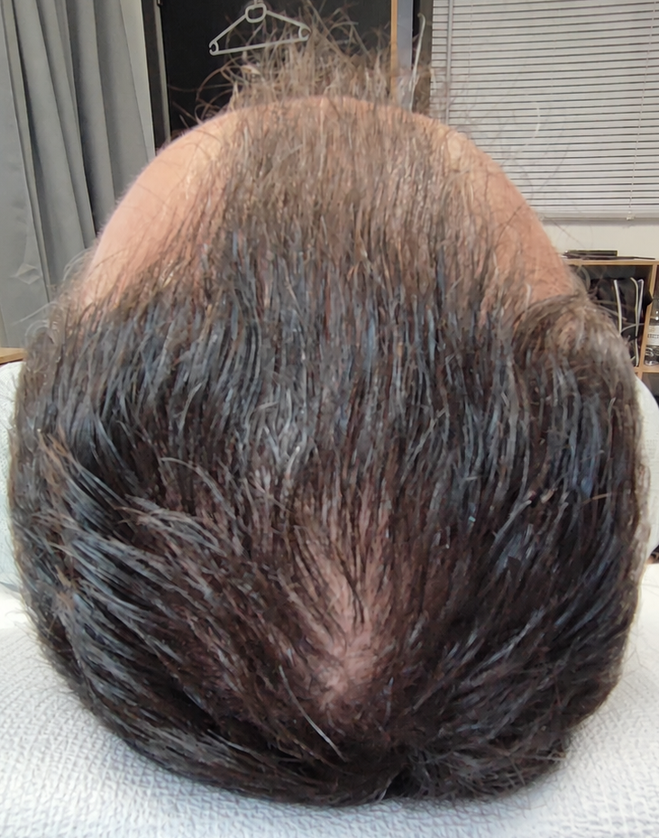 Vertex clairsemé avant la première séance RegenX - Regen'HairSkin