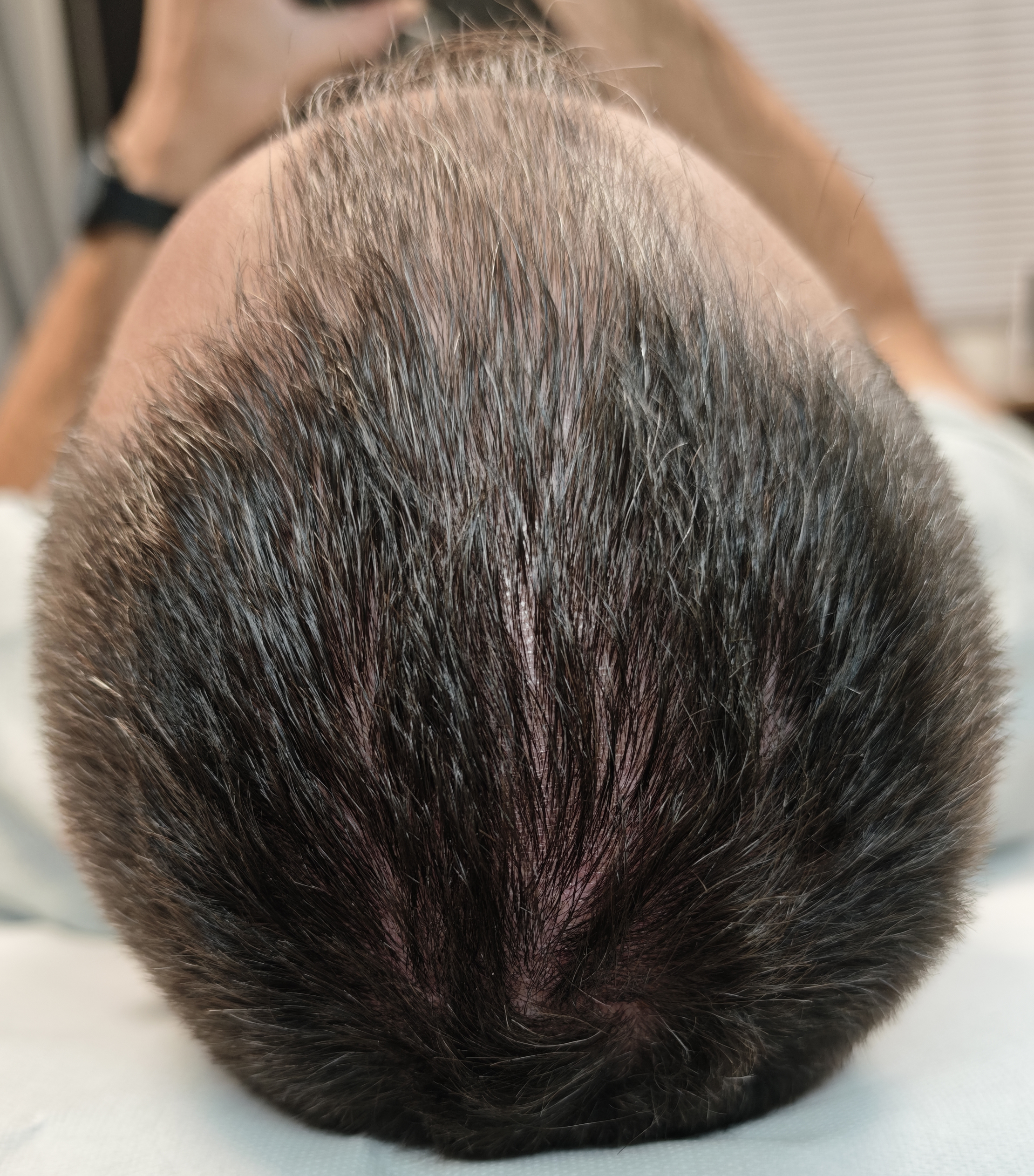 Vertex clairsemé avant la cinquième séance RegenX - Regen'HairSkin
