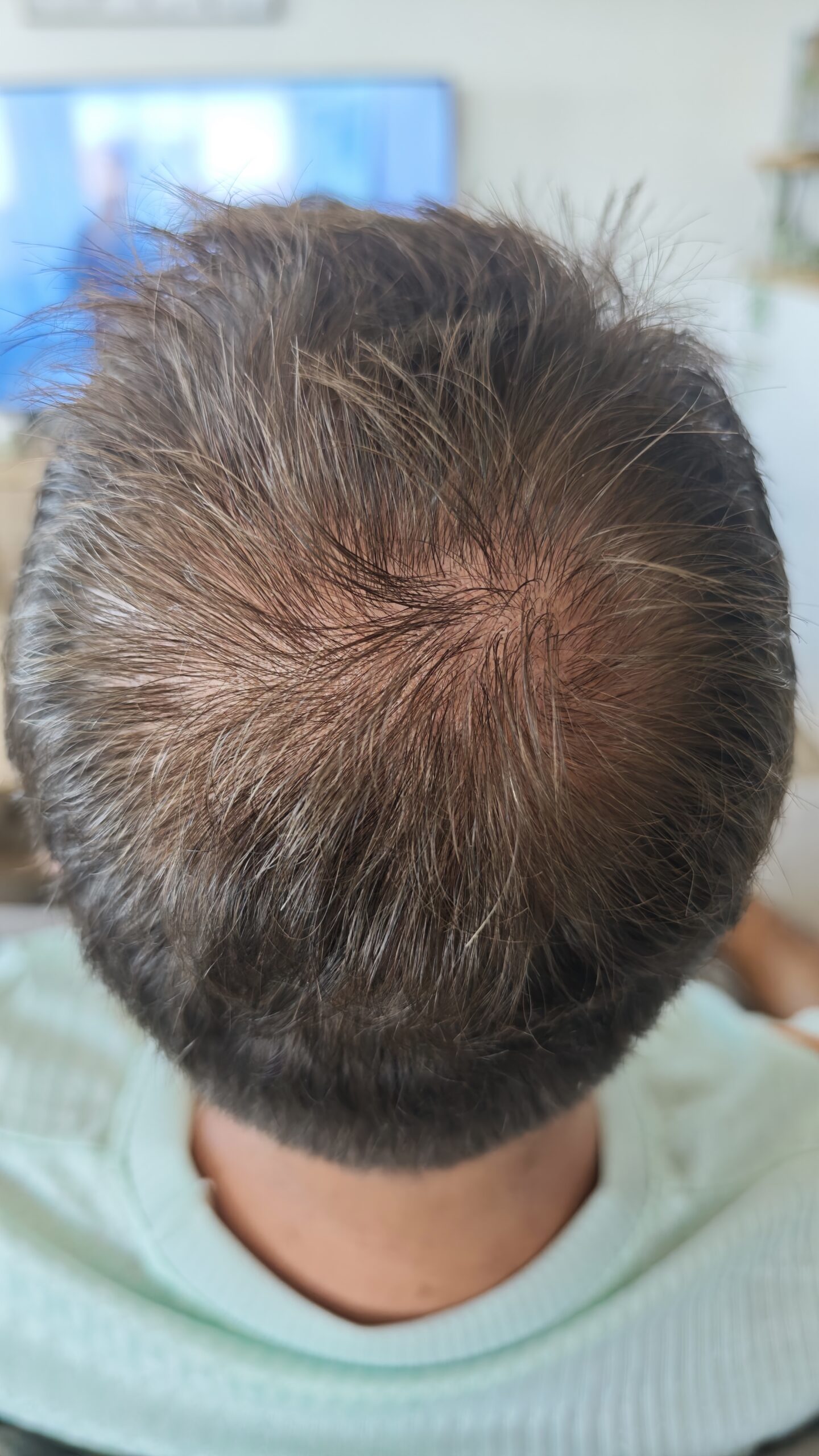Vertex après cinq séances RegenX - Regen'HairSkin