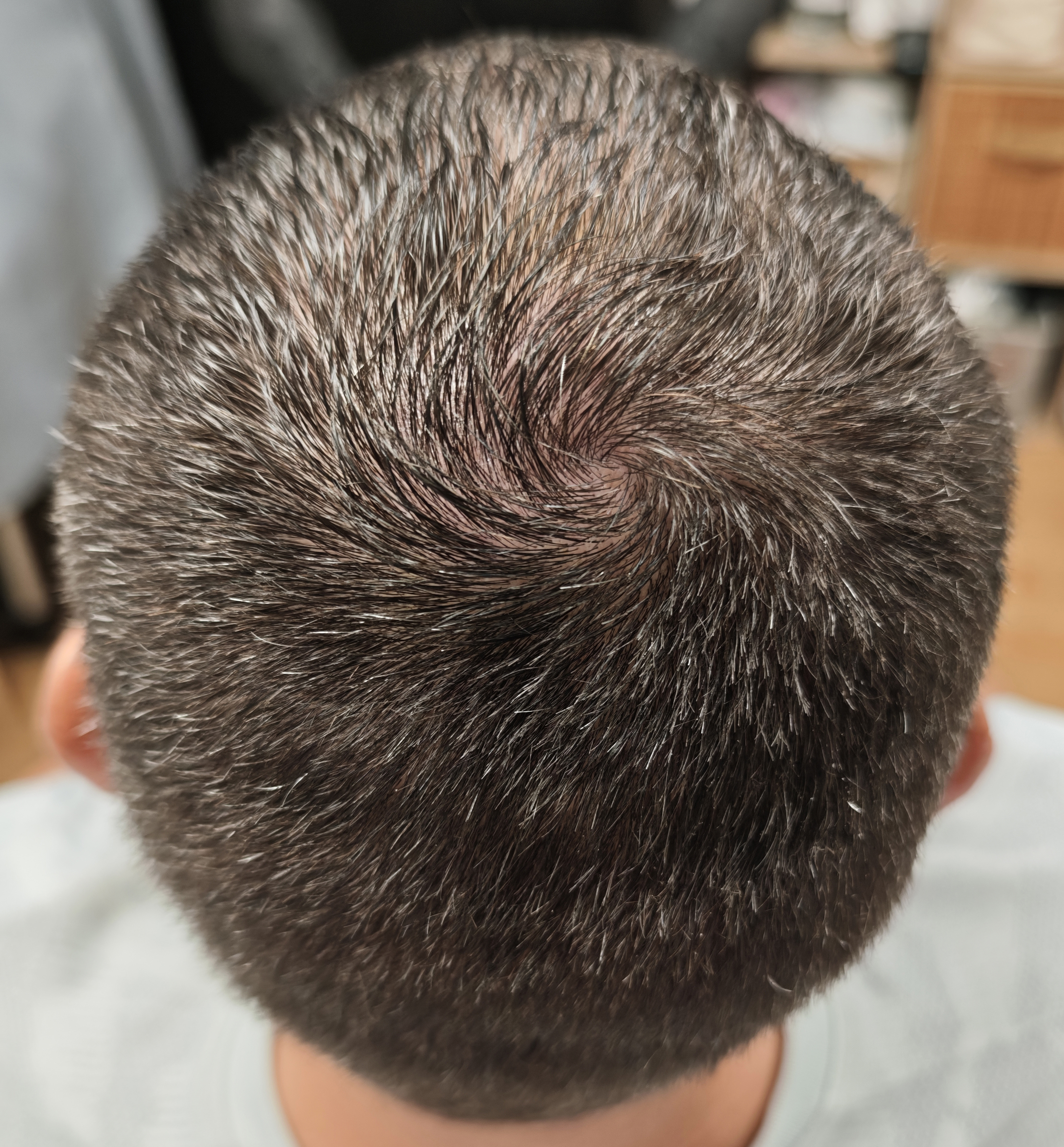 Vertex clairsemé avant la cinquième séance RegenX - Regen'HairSkin