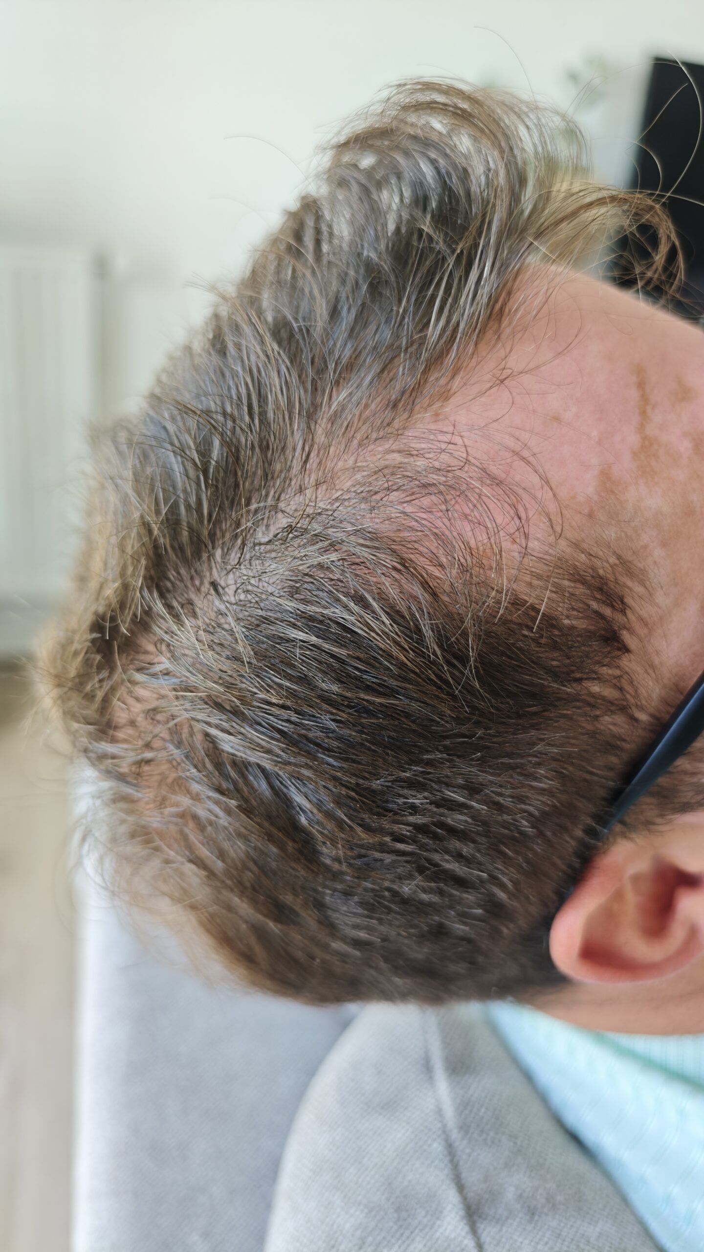 Golfes dégarnis et ligne frontale après la méthode RegenX - Regen'HairSkin