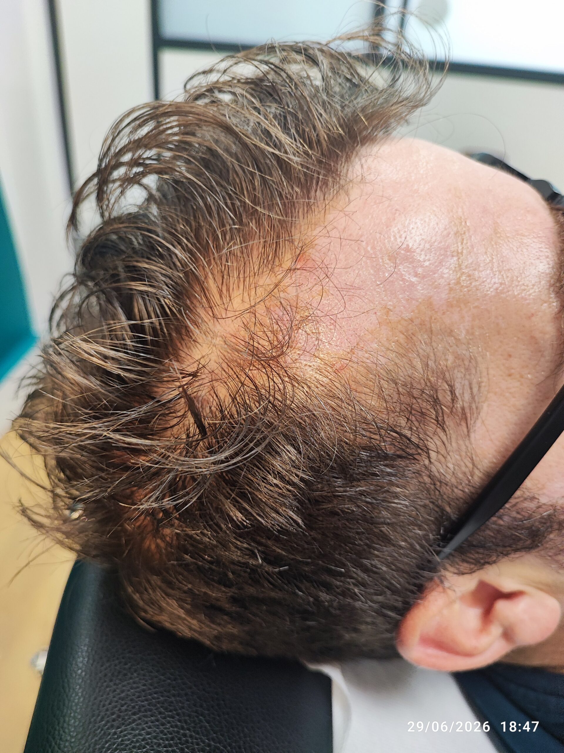 Golfes dégarnis et ligne frontale reculée avant la méthode RegenX - Regen'HairSkin